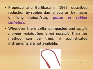 • Propescu and Burlibasa in 1966, described
reduction by rubber dam sheets or by means
of long ribbon/strip gauze or rubber
catheters.
• Whenever the maxilla is impacted and simple
manual mobilization is not possible, then this
method can be tried, if sophisticated
instruments are not available.
38
 