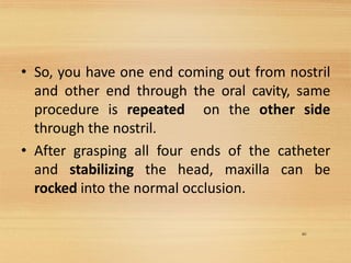 40
• So, you have one end coming out from nostril
and other end through the oral cavity, same
procedure is repeated on the other side
through the nostril.
• After grasping all four ends of the catheter
and stabilizing the head, maxilla can be
rocked into the normal occlusion.
 