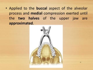 • Applied to the buccal aspect of the alveolar
process and medial compression exerted until
the two halves of the upper jaw are
approximated.
45
 