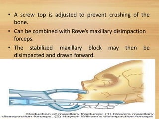 • A screw top is adjusted to prevent crushing of the
bone.
• Can be combined with Rowe’s maxillary disimpaction
forceps.
• The stabilized maxillary block may then be
disimpacted and drawn forward.
46
 