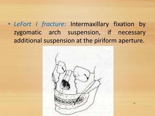• LeFort I fracture: Intermaxillary fixation by
zygomatic arch suspension, if necessary
additional suspension at the piriform aperture.
56
 