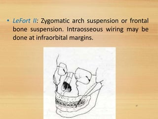 • LeFort II: Zygomatic arch suspension or frontal
bone suspension. Intraosseous wiring may be
done at infraorbital margins.
57
 