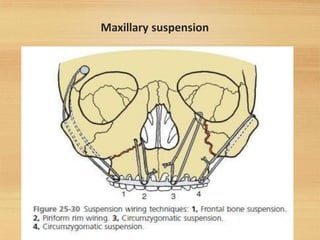 Maxillary suspension
59
 