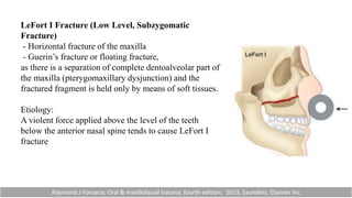 LeFort I Fracture (Low Level, Subzygomatic
Fracture)
- Horizontal fracture of the maxilla
- Guerin’s fracture or floating fracture,
as there is a separation of complete dentoalveolar part of
the maxilla (pterygomaxillary dysjunction) and the
fractured fragment is held only by means of soft tissues.
Etiology:
A violent force applied above the level of the teeth
below the anterior nasal spine tends to cause LeFort I
fracture
Raymond.J Fonseca; Oral & maxillofacial trauma; fourth edition; 2013, Saunders, Elsevier Inc
 
