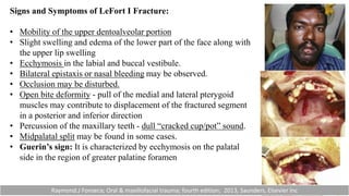 Signs and Symptoms of LeFort I Fracture:
• Mobility of the upper dentoalveolar portion
• Slight swelling and edema of the lower part of the face along with
the upper lip swelling
• Ecchymosis in the labial and buccal vestibule.
• Bilateral epistaxis or nasal bleeding may be observed.
• Occlusion may be disturbed.
• Open bite deformity - pull of the medial and lateral pterygoid
muscles may contribute to displacement of the fractured segment
in a posterior and inferior direction
• Percussion of the maxillary teeth - dull “cracked cup/pot” sound.
• Midpalatal split may be found in some cases.
• Guerin’s sign: It is characterized by ecchymosis on the palatal
side in the region of greater palatine foramen
Raymond.J Fonseca; Oral & maxillofacial trauma; fourth edition; 2013, Saunders, Elsevier Inc
 