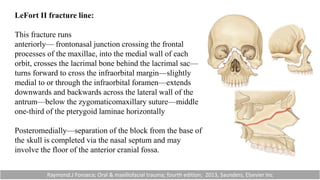 LeFort II fracture line:
This fracture runs
anteriorly— frontonasal junction crossing the frontal
processes of the maxillae, into the medial wall of each
orbit, crosses the lacrimal bone behind the lacrimal sac—
turns forward to cross the infraorbital margin—slightly
medial to or through the infraorbital foramen—extends
downwards and backwards across the lateral wall of the
antrum—below the zygomaticomaxillary suture—middle
one-third of the pterygoid laminae horizontally
Posteromedially—separation of the block from the base of
the skull is completed via the nasal septum and may
involve the floor of the anterior cranial fossa.
Raymond.J Fonseca; Oral & maxillofacial trauma; fourth edition; 2013, Saunders, Elsevier Inc
 