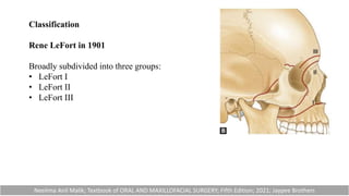 Classification
Rene LeFort in 1901
Broadly subdivided into three groups:
• LeFort I
• LeFort II
• LeFort III
Neelima Anil Malik; Textbook of ORAL AND MAXILLOFACIAL SURGERY; Fifth Edition; 2021; Jaypee Brothers
 