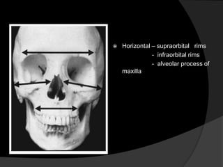 

Horizontal – supraorbital rims
- infraorbital rims
- alveolar process of
maxilla

 