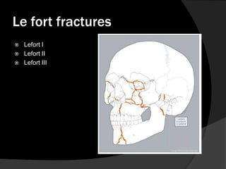 Le fort fractures




Lefort I
Lefort II
Lefort III

 