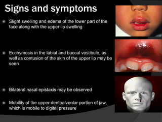 Signs and symptoms


Slight swelling and edema of the lower part of the
face along with the upper lip swelling



Ecchymosis in the labial and buccal vestibule, as
well as contusion of the skin of the upper lip may be
seen



Bilateral nasal epistaxis may be observed



Mobility of the upper dentoalveolar portion of jaw,
which is mobile to digital pressure

 