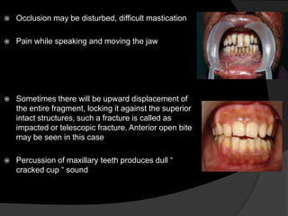 

Occlusion may be disturbed, difficult mastication



Pain while speaking and moving the jaw



Sometimes there will be upward displacement of
the entire fragment, locking it against the superior
intact structures, such a fracture is called as
impacted or telescopic fracture. Anterior open bite
may be seen in this case



Percussion of maxillary teeth produces dull “
cracked cup “ sound

 