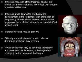 

If there is impaction of the fragment against the
cranial base then shortening of the face with anterior
open bite will be seen



If there is gross downward and backward
displacement of the fragement then elongation or
lengthening of the face will be seen with posterior
gagging of the occlusion with anterior open bite(Dish
shaped face)



Bilateral epistaxis may be present



Difficulty in mastication and speech, due to
derranged occlusion may be seen



Airway obstruction may be seen due to posterior
and downward displacement of the fragement
impinging on the dorsum of the tongue

 