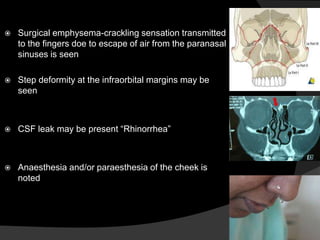 

Surgical emphysema-crackling sensation transmitted
to the fingers doe to escape of air from the paranasal
sinuses is seen



Step deformity at the infraorbital margins may be
seen



CSF leak may be present “Rhinorrhea”



Anaesthesia and/or paraesthesia of the cheek is
noted

 