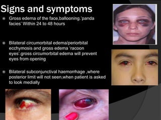Signs and symptoms


Gross edema of the face,ballooning.‟panda
facies‟ Within 24 to 48 hours



Bilateral circumorbital edema/periorbital
ecchymosis and gross edema „racoon
eyes‟.gross circumorbital edema will prevent
eyes from opening



Bilateral subconjunctival haemorrhage ,where
posterior limit will not seen,when patient is asked
to look medially

 