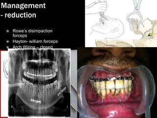 Management
- reduction





Rowe‟s disimpaction
forceps
Hayton- william forceps
Arch Wiring – closed
method

 