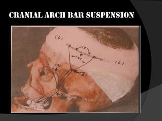 CRANIAL ARCH BAR SUSPENSION

 