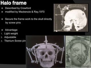Halo frame






1.
2.
3.

Described by Crawford
modified by Mackenzie & Ray,1970
Secure the frame work to the skull directly
by screw pins
Advantage:
Light weight
Adjustable
Titanium Screw pin

 