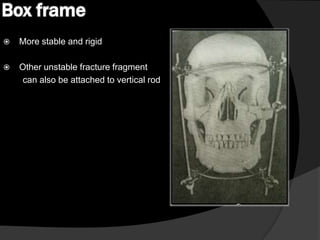 Box frame


More stable and rigid



Other unstable fracture fragment
can also be attached to vertical rod

 