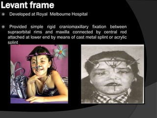 Levant frame



Developed at Royal Melbourne Hospital
Provided simple rigid craniomaxillary fixation between
supraorbital rims and maxilla connected by central rod
attached at lower end by means of cast metal splint or acrylic
splint

 