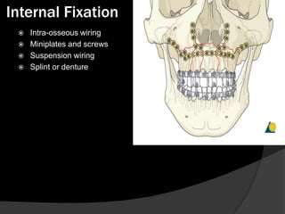 Internal Fixation





Intra-osseous wiring
Miniplates and screws
Suspension wiring
Splint or denture

 