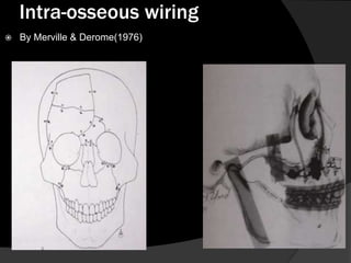 Intra-osseous wiring


By Merville & Derome(1976)

 