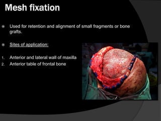 Mesh fixation


Used for retention and alignment of small fragments or bone
grafts.



Sites of application:

1.

Anterior and lateral wall of maxilla
Anterior table of frontal bone

2.

 