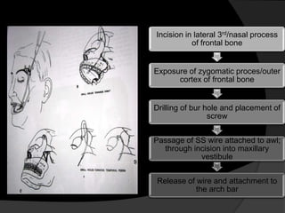Incision in lateral 3rd/nasal process
of frontal bone

Exposure of zygomatic proces/outer
cortex of frontal bone

Drilling of bur hole and placement of
screw
Passage of SS wire attached to awl;
through incision into maxillary
vestibule
Release of wire and attachment to
the arch bar

 