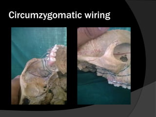 Circumzygomatic wiring

 