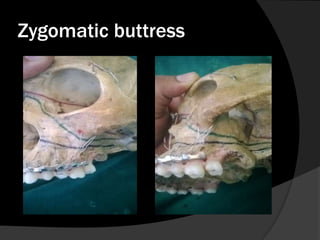 Zygomatic buttress

 