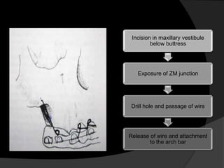 Incision in maxillary vestibule
below buttress

Exposure of ZM junction

Drill hole and passage of wire

Release of wire and attachment
to the arch bar

 