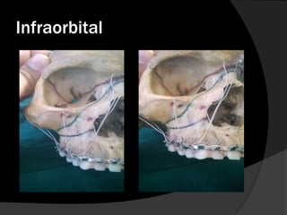 Infraorbital

 