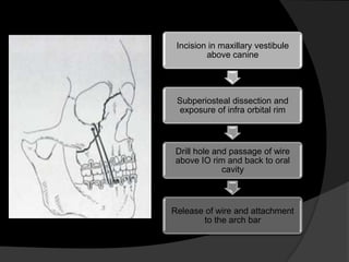 Incision in maxillary vestibule
above canine

Subperiosteal dissection and
exposure of infra orbital rim

Drill hole and passage of wire
above IO rim and back to oral
cavity

Release of wire and attachment
to the arch bar

 