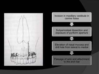 Incision in maxillary vestibule in
canine fossa

Subperiosteal dissection and
exposure of pyriform aperture

Elevation of nasal mucosa and
drill hole from lateral to medial

Passage of wire and attachment
to the arch bar

 