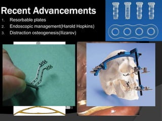 Recent Advancements
1.
2.
3.

Resorbable plates
Endoscopic management(Harold Hopkins)
Distraction osteogenesis(Ilizarov)

 