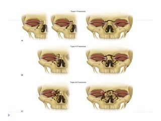 Mid facial fractures | PPTX