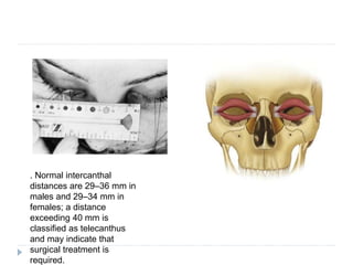 Mid facial fractures | PPTX