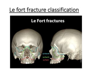 Fort Classification MID FACE FRACTURES.pptx