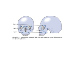 MID FACE FRACTURES.pptx