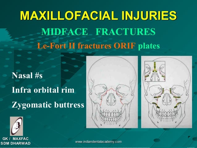 Mid face fractures#2 /certified fixed orthodontic courses by Indian