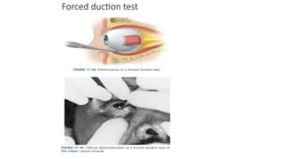 MIDFACE FRACTURES omfs mds final123.pptx