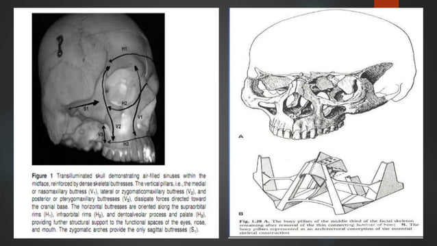 Midface fractures | PPTX