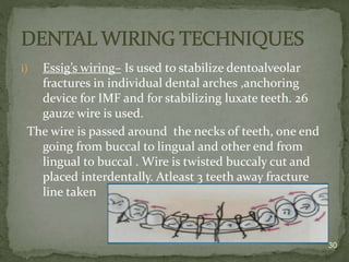 Essig Splinting Midfacial fractures - oral surgery b.d.s | PPTX