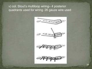 Stout Wire Midfacial fractures - oral surgery b.d.s | PPTX