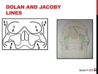 Mid facial trauma OMR final year part 1.pdf