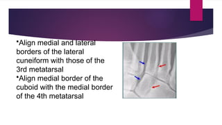 MIDFOOT AND FOREFOOT FRACTURES,LISFRANCS INJURY DHERAJ.pptx