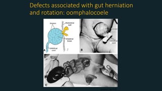 Defects associated with gut herniation
and rotation: oomphalocoele
Langman’s fig 14-31
 