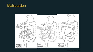 Malrotation
Slide from S Baker, MD
 