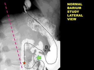 NORMAL
BARIUM
STUDY
LATERAL
VIEW
 