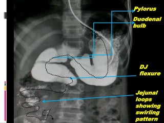 Pylorus
Duodenal
bulb
DJ
flexure
Jejunal
loops
showing
swirling
pattern
 