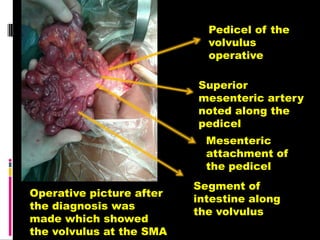 Pedicel of the
volvulus
operative
Superior
mesenteric artery
noted along the
pedicel
Mesenteric
attachment of
the pedicel
Segment of
intestine along
the volvulus
Operative picture after
the diagnosis was
made which showed
the volvulus at the SMA
 